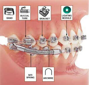 Orthodontic Breakages