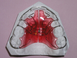 URA for Expansion, Retention and Tooth Movement