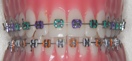 Metal Braces